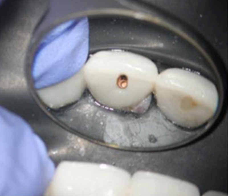 Before EdgePRO Procedure