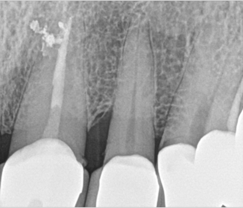 After EdgePRO Procedure