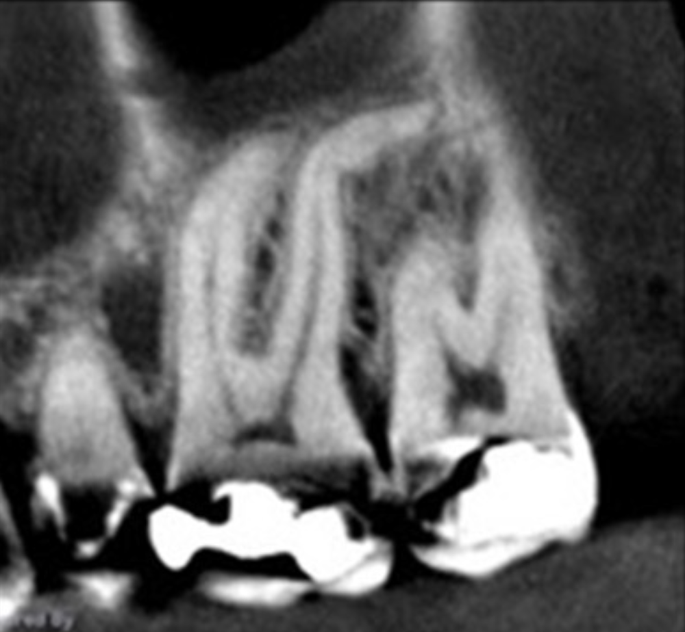 Before EdgePRO Procedure