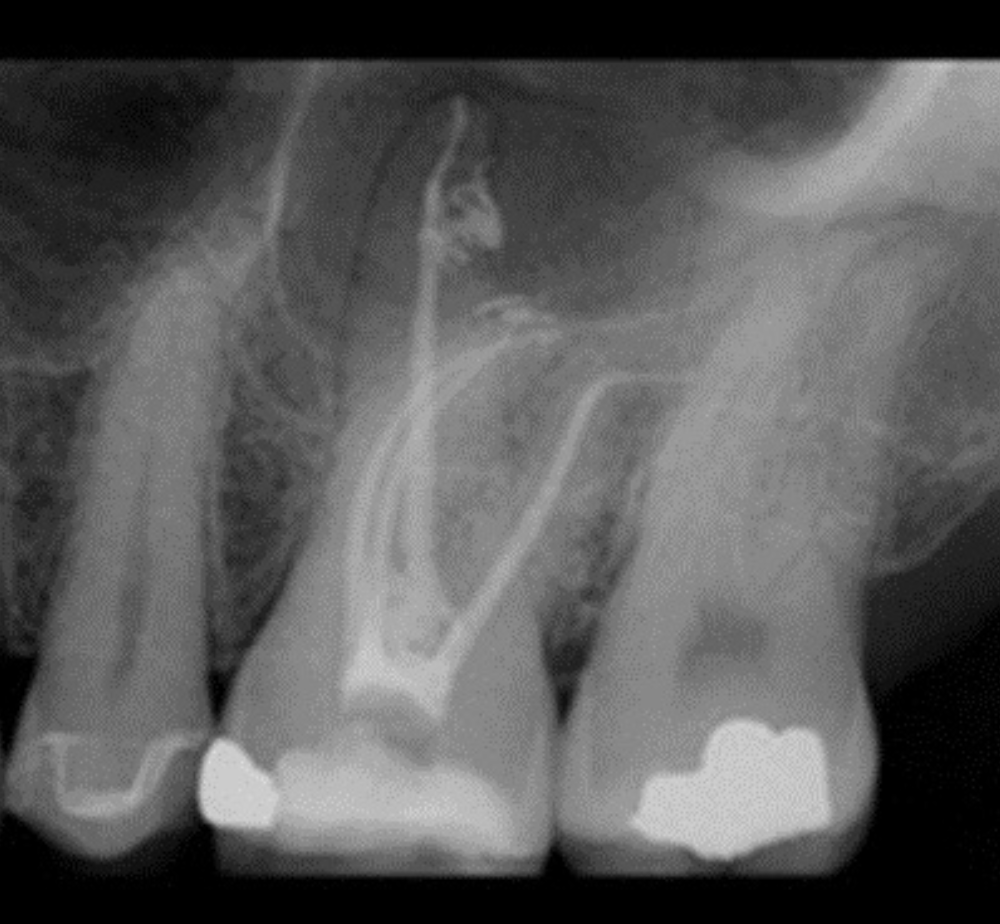 After EdgePRO Procedure