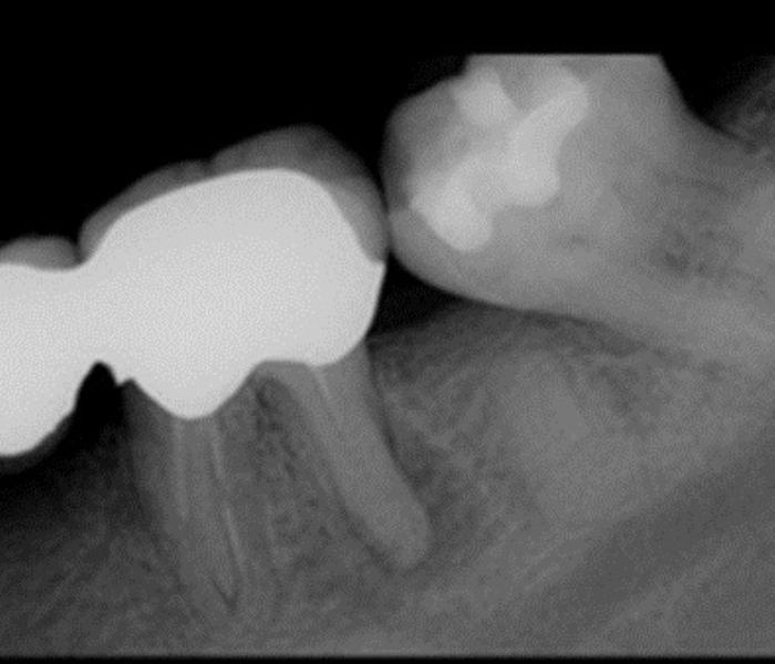 Before EdgePRO Procedure