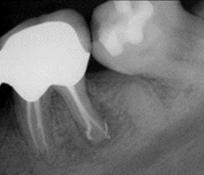 After EdgePRO Procedure