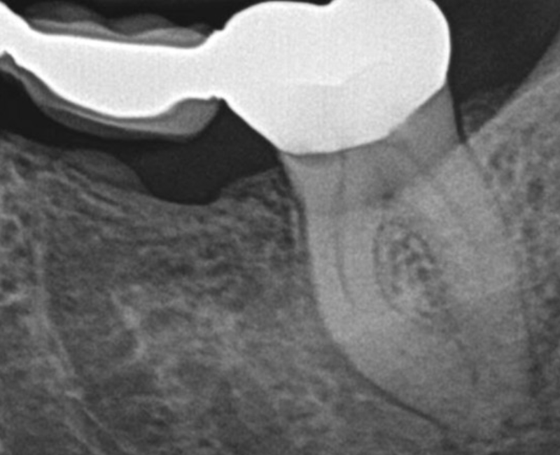Before EdgePRO Procedure