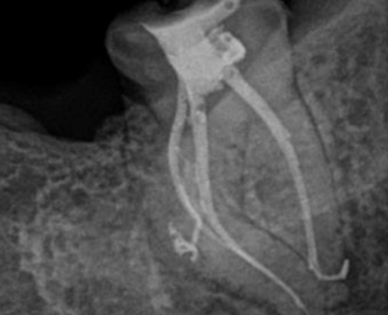 After EdgePRO Procedure